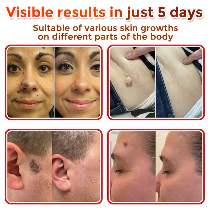 The AuraClear Skin Tag Patch - Botanic MicroNeedle Removal, Visible Results + 50% OFF