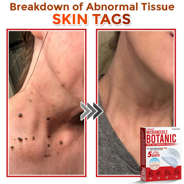 The MicroDerm Patch - Painless Skin Tag &amp; Blemish Removal + 50% OFF