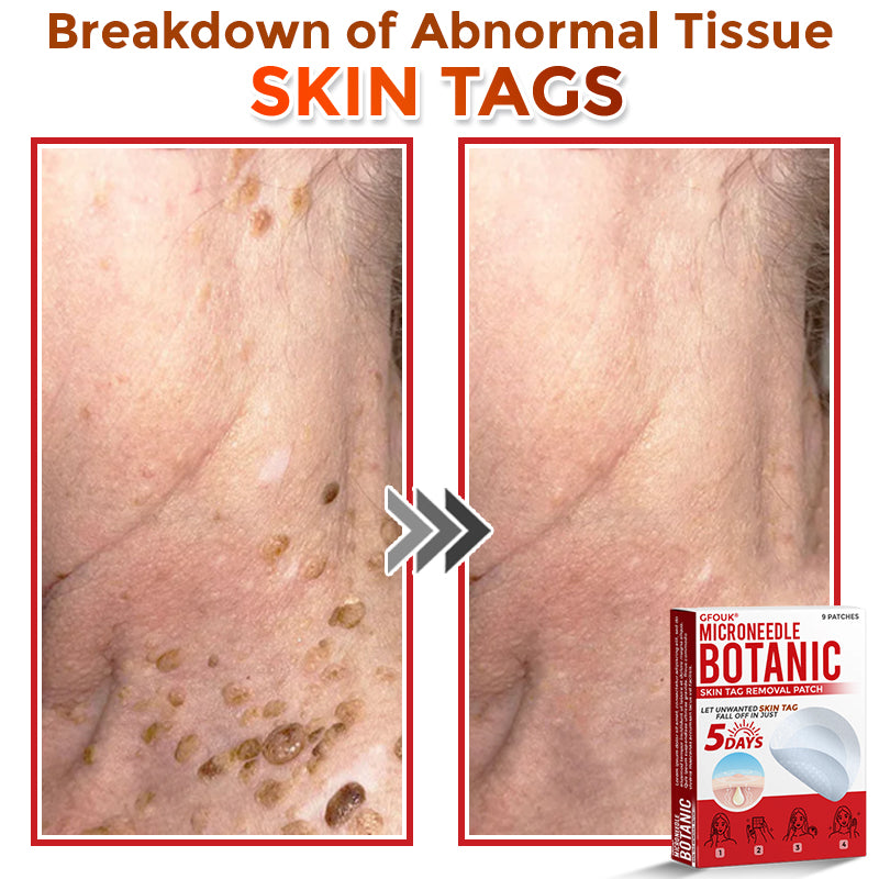 The AuraClear Skin Tag Patch - Botanic MicroNeedle Removal, Visible Results + 50% OFF