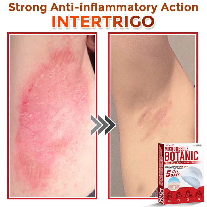 The AuraClear Skin Tag Patch - Botanic MicroNeedle Removal, Visible Results + 50% OFF
