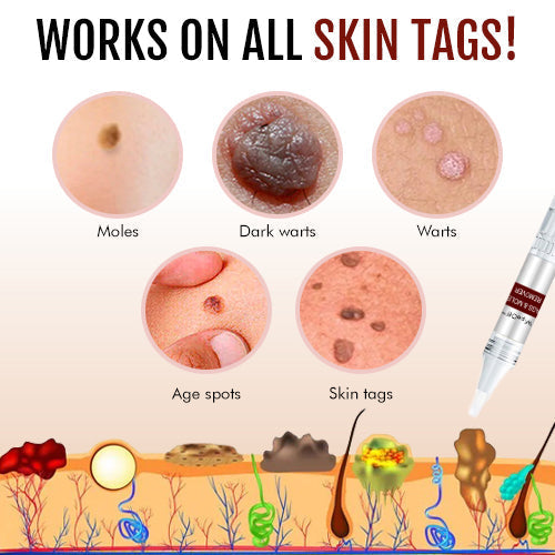1 + 1 Free - WipeOff™ Marker &amp; Mole Remover